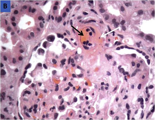 Test Your Knowledge: Lupus Nephritis & Thrombotic Microangiopathy ...