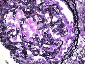Recurrent And De Novo FSGS Following Kidney Transplantation AJKD Blog