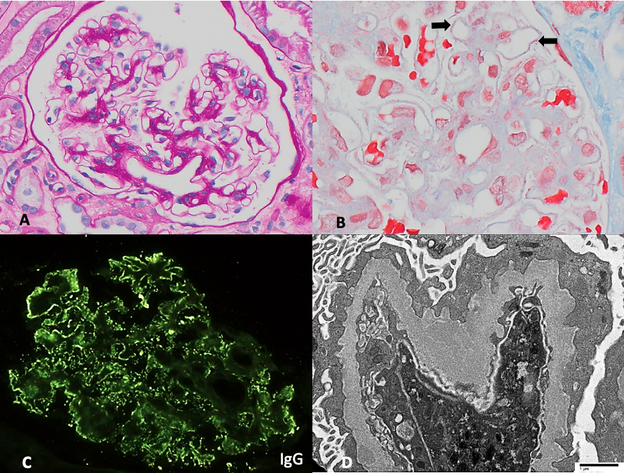 membranous nephropathy – AJKD Blog