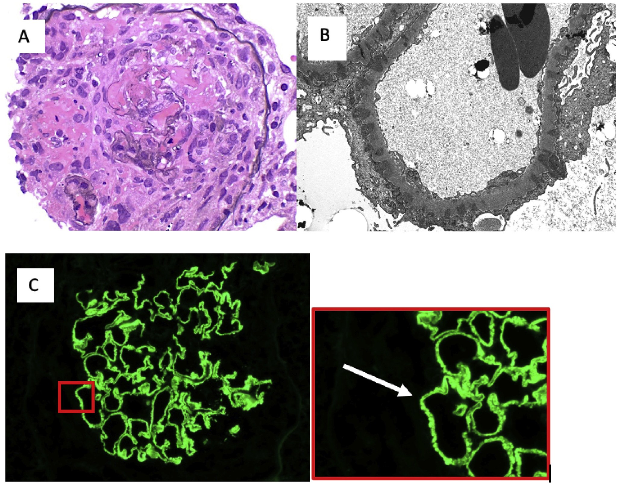 PathPointer Concurrent antiGBM disease and Membranous Nephropathy